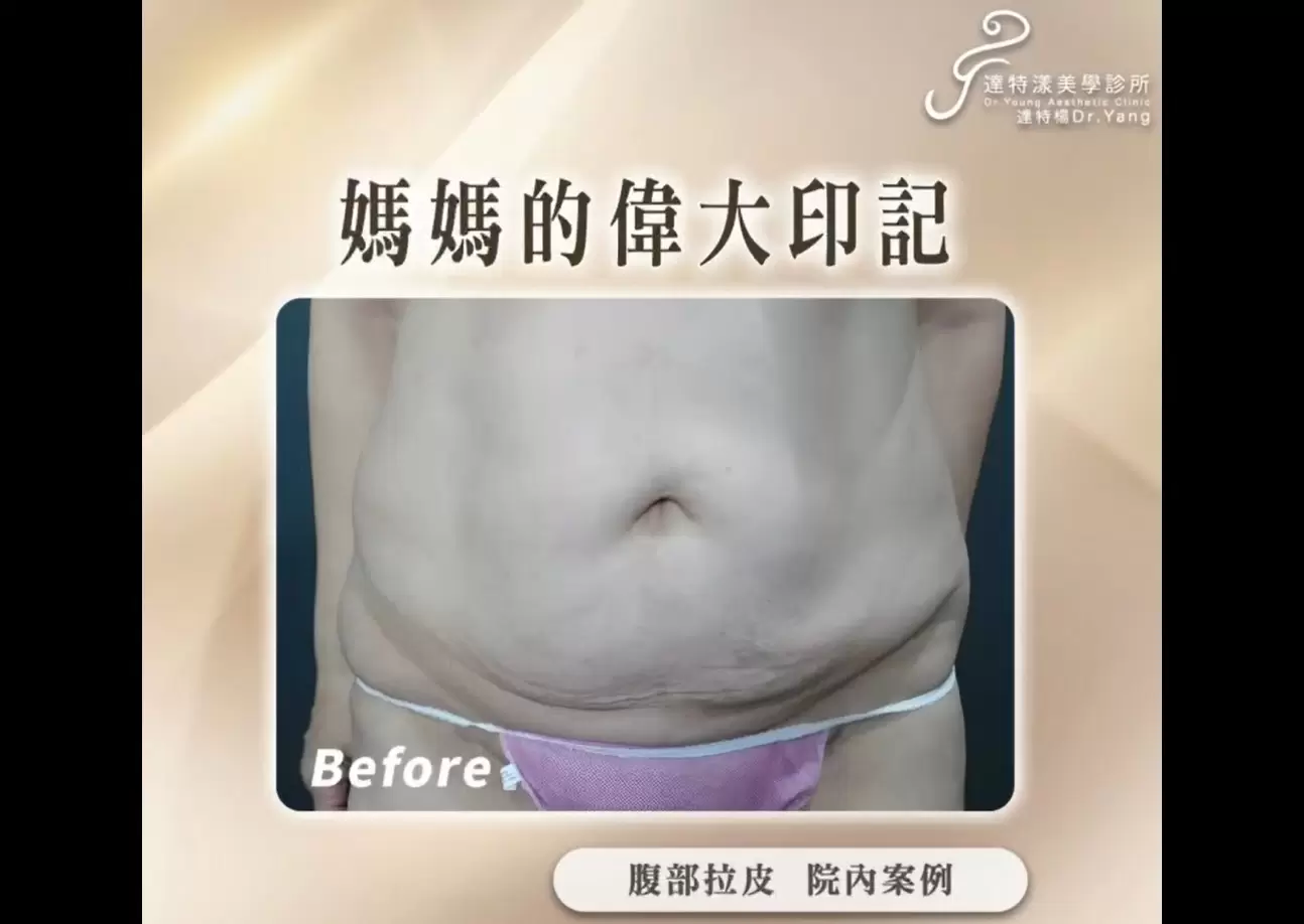 高雄整形外科 腹部拉皮 媽媽偉大的印記