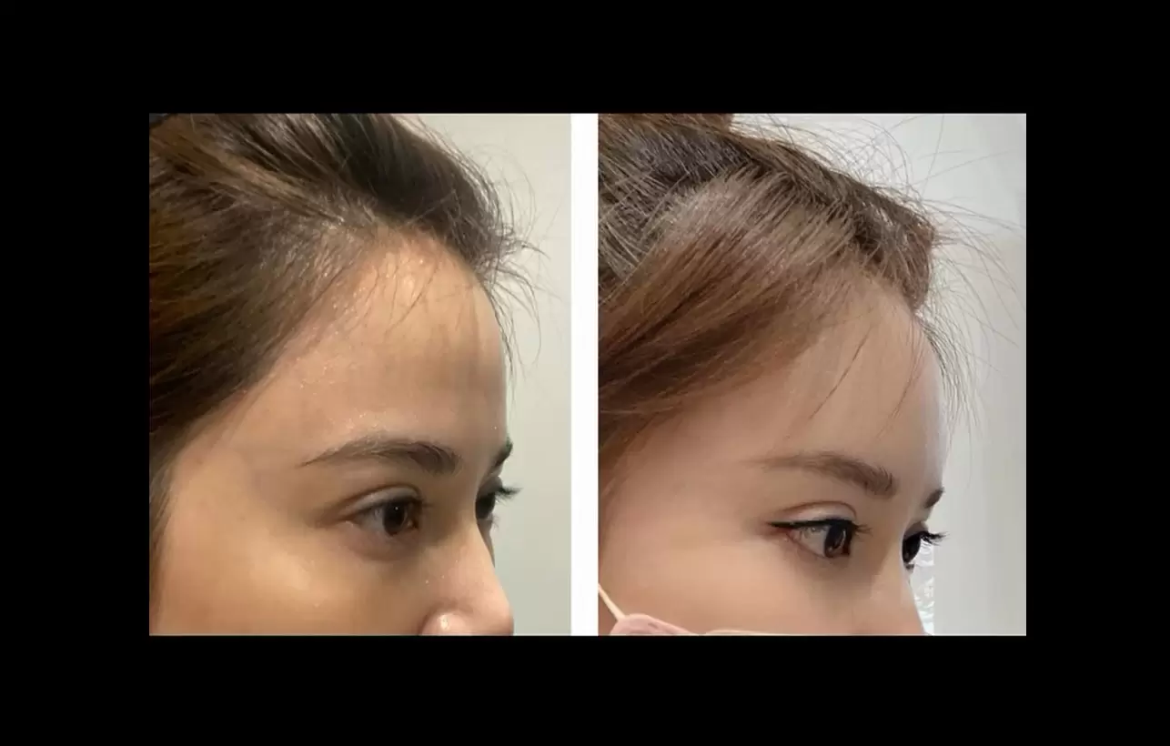 洢蓮絲Ellansé融合玻尿酸和膠原蛋白增生劑客製化豐額精緻輪廓從額頭開始