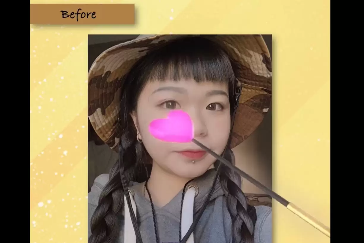 掰掰蒜頭鼻 高雄整形外科院內案例 三段式隆鼻＋縮鼻翼 晉升精緻甜美妞