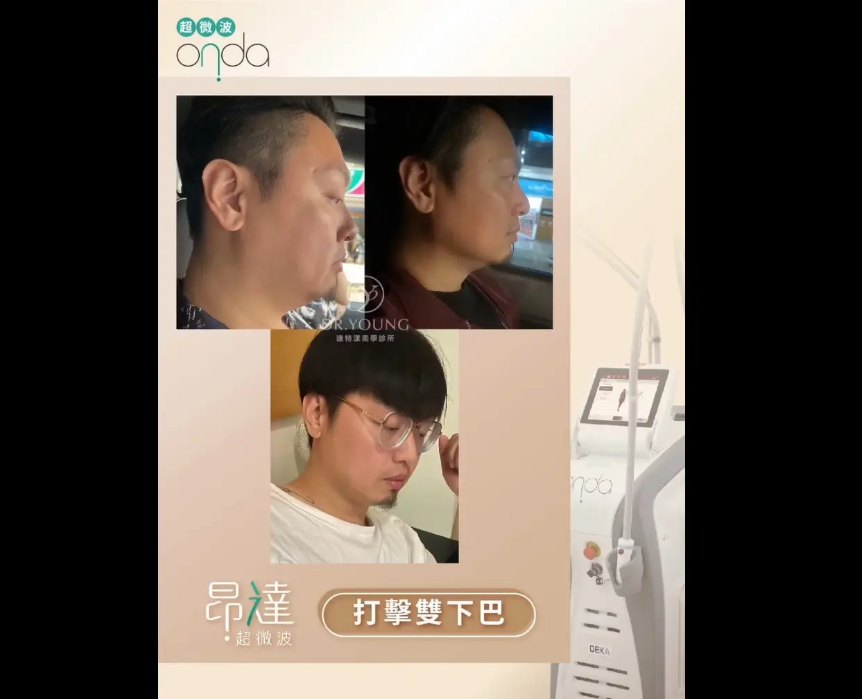 昂達超微波ONDA 代謝多餘脂肪 下顎線雕塑設計 輪廓線精修體驗正式啟動