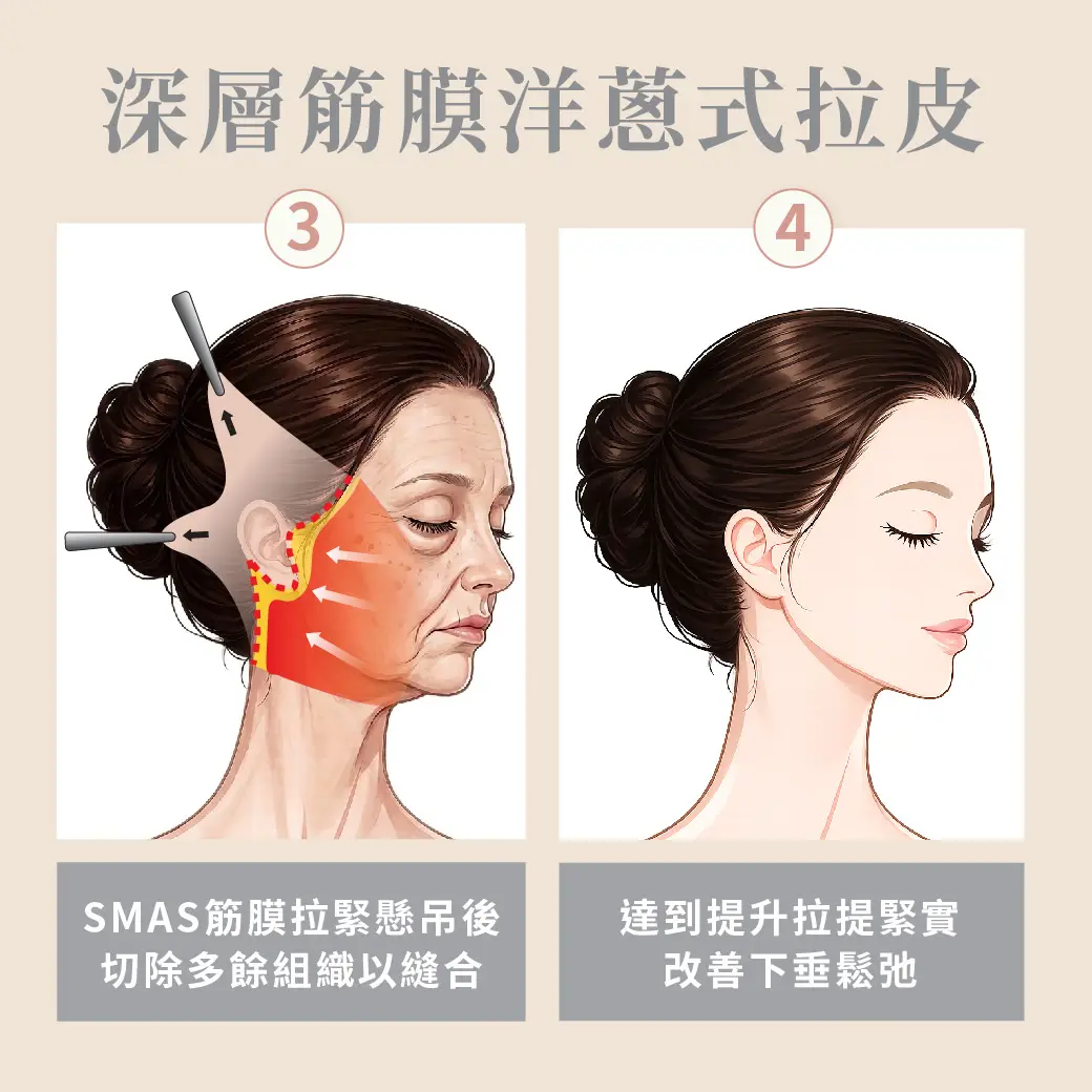 清晰的輪廓線條提升減齡顏值的高級感│中下臉拉皮 整形外科