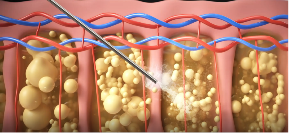 特殊超音波能量在細胞間產⽣氣泡，使脂肪團塊溫和乳糜化。