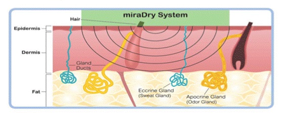 miraDry的治療原理是透過最理想的微波頻率5.8GHz，精準地將能量傳遞並聚集至汗腺分布的區域。清新微波miraDry腋下多汗。高雄狐臭多汗