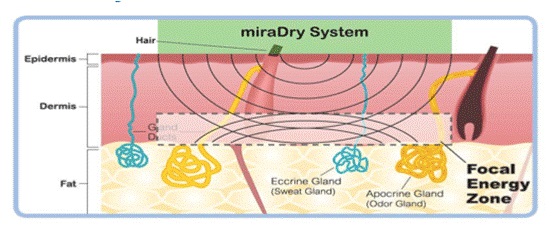 清新微波miraDry腋下多汗，達特楊美學診所，高雄狐臭多汗。利用不同介質的電磁性能差異形成反射，進而改善腋下多汗。
