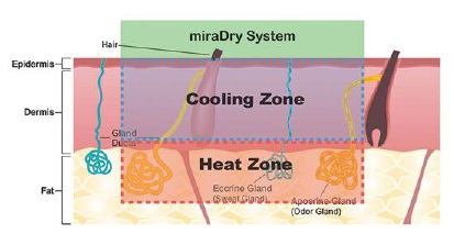 達特楊美學診所，高雄狐臭多汗。miraDry能量聚集區溫度維持60-70℃，有效破壞汗腺。