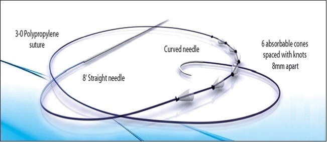 埋線拉皮合法材質有哪些？詩立愛塑型線（SILHOUETTE SUTURES）、QUILL(又稱羽毛線)、V-LOC(又稱玫瑰線)、藍鑽魚骨線四種，此四者於國內外已累積不少臨床案例，是消費者可以安心選擇的線材。