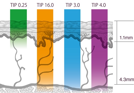 thermage FLX® (俗稱)鳳凰電波,深層激活膠原蛋白新生力