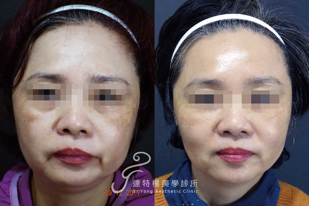 高雄埋線拉提,院內案例。達特楊美學診所