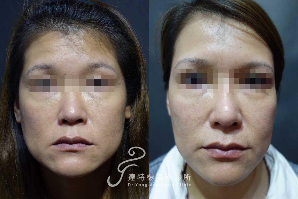 高雄埋線拉提,院內案例。達特楊美學診所