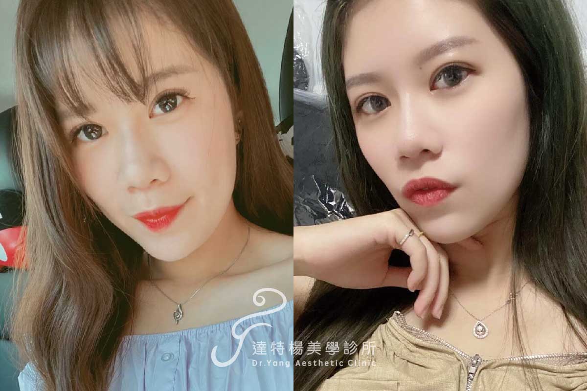 鼻雕線 院內案例。達特楊美學診所,高雄埋線拉提