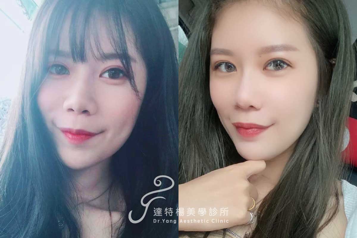 鼻雕線 院內案例。達特楊美學診所,高雄埋線拉提