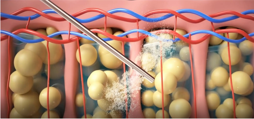 注⼊腫脹麻醉液,軟化脂肪組織。