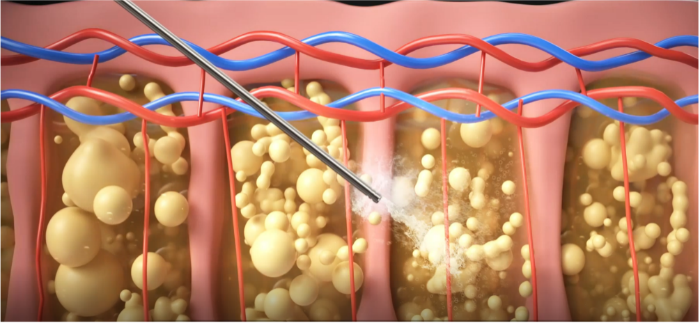 特殊超音波能量在細胞間產⽣氣泡,使脂肪團塊溫和乳糜化。