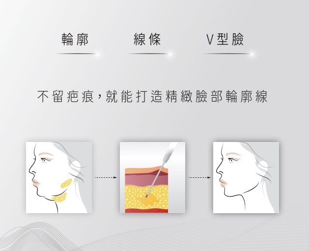 高雄音波脂雕。不留包痕,就能打造精緻臉部輪廓。