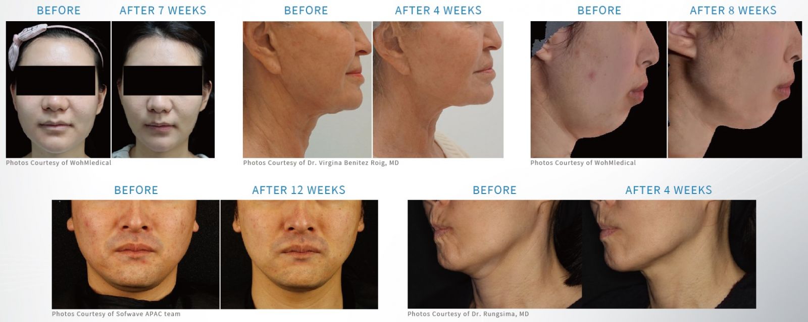 眉眼鬆弛無神,臉部皺紋、頸紋,下半臉輪廓線模糊,雙下巴、嘴邊肉明顯,皮膚觸感鬆垂。改善眉眼拉提、臉龐景緻彈潤、輪廓線精緻、淡化皺紋細紋。